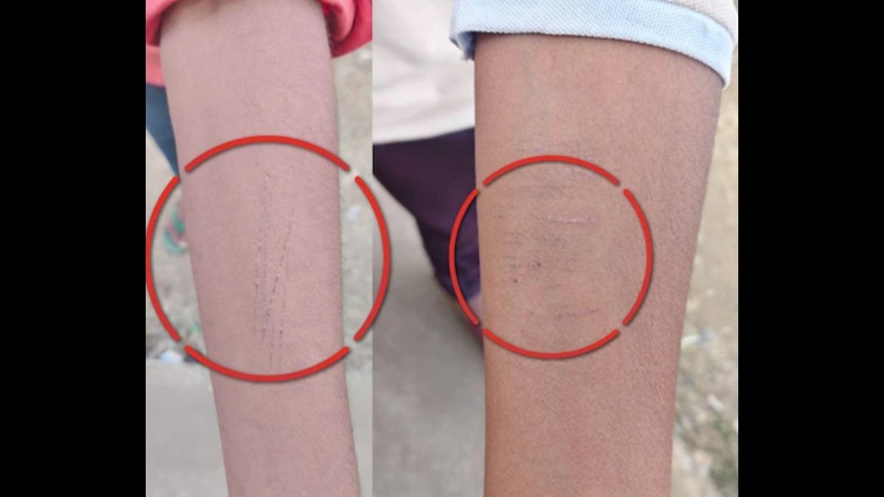 छत्तीसगढ़ के धमतरी स्कूल में सनसनी: 35 से ज्यादा बच्चों ने ब्लेड से हाथ काटे, प्रशासन ने शुरू की जांच